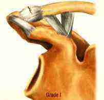 AC Joint Separation Grade 1