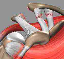 Ac Joint Separation