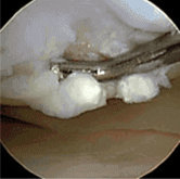 Articular Cartilage Damaged