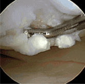 Articular Cartilage Damaged procedure photo