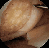 Operation to Stimulate Cartilage Growth (Initial Step) procedure photo