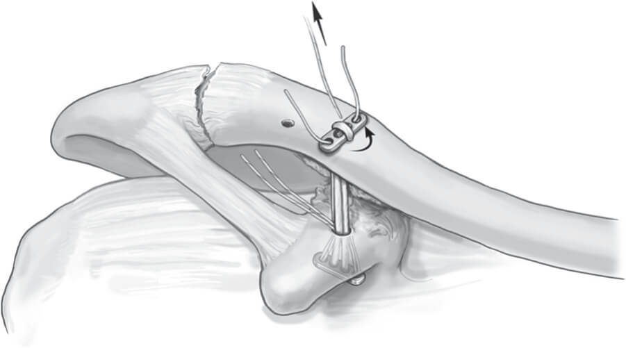 Double Endobutton Technique for Repair of Complete Acromioclavicular Joint Dislocations Figure 5