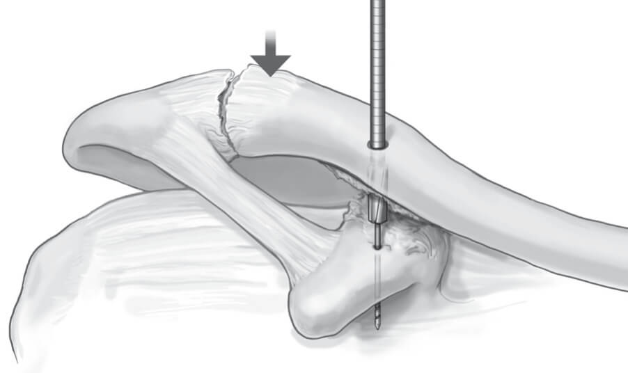 🥇 AC Shoulder Joint Separation Grading