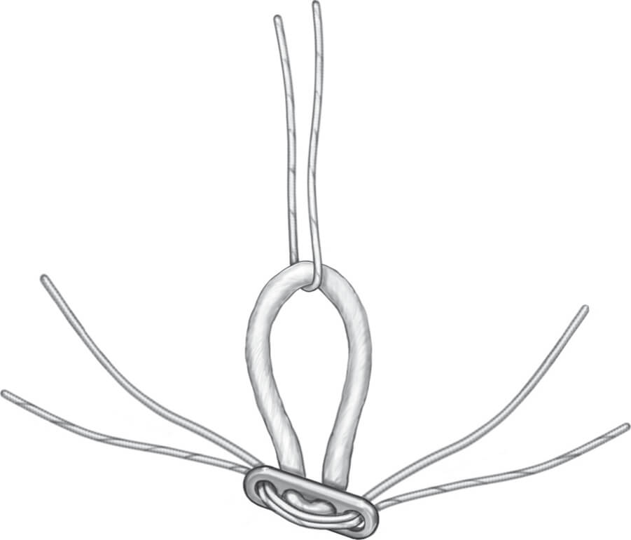 Double Endobutton Technique for Repair of Complete Acromioclavicular Joint Dislocations Figure 2