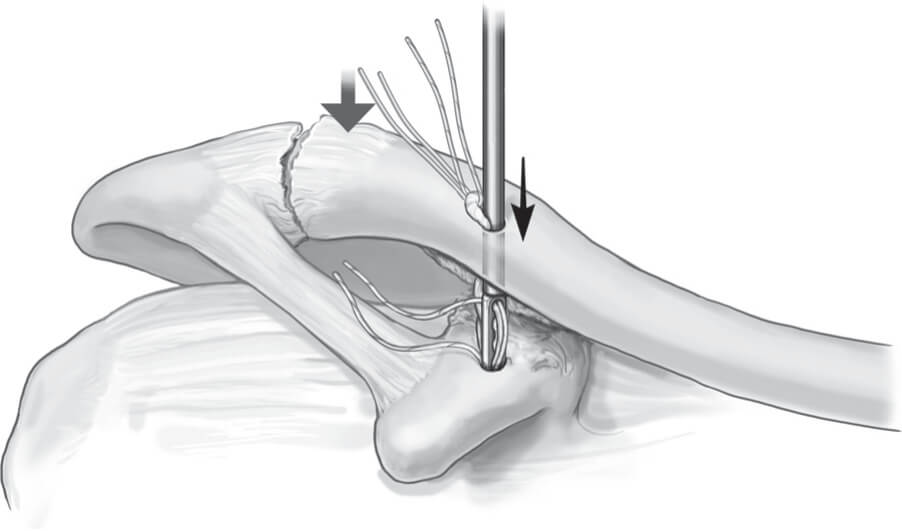 Double Endobutton Technique for Repair of Complete Acromioclavicular Joint Dislocations Figure 3