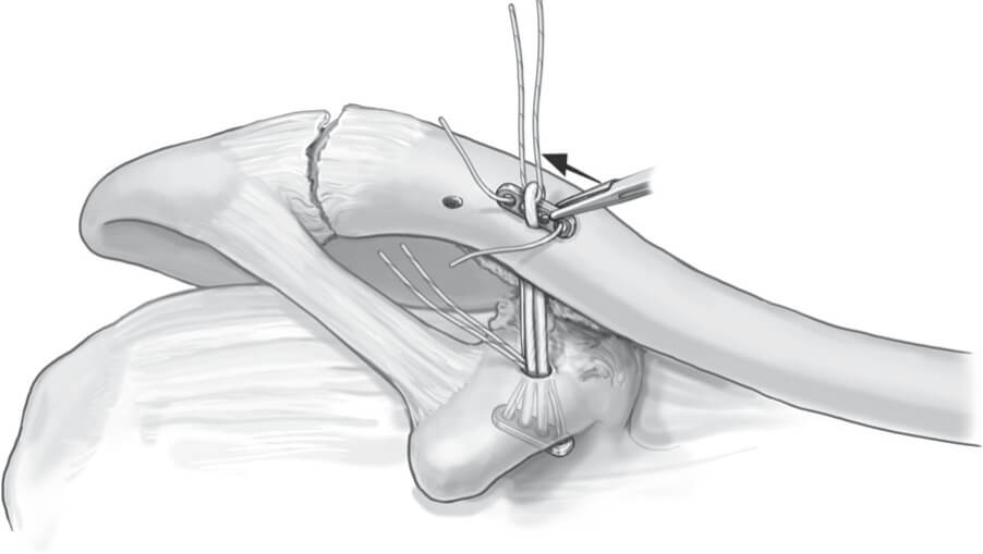 Double Endobutton Technique for Repair of Complete Acromioclavicular Joint Dislocations Figure 4