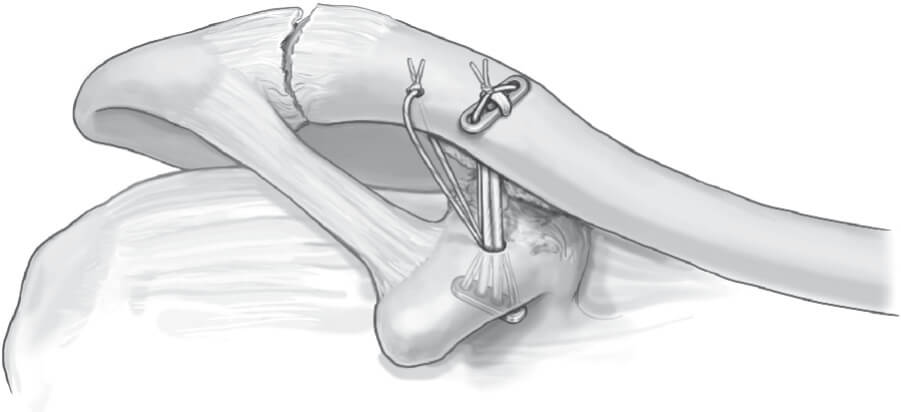 Double Endobutton Technique for Repair of Complete Acromioclavicular Joint Dislocations Figure 6