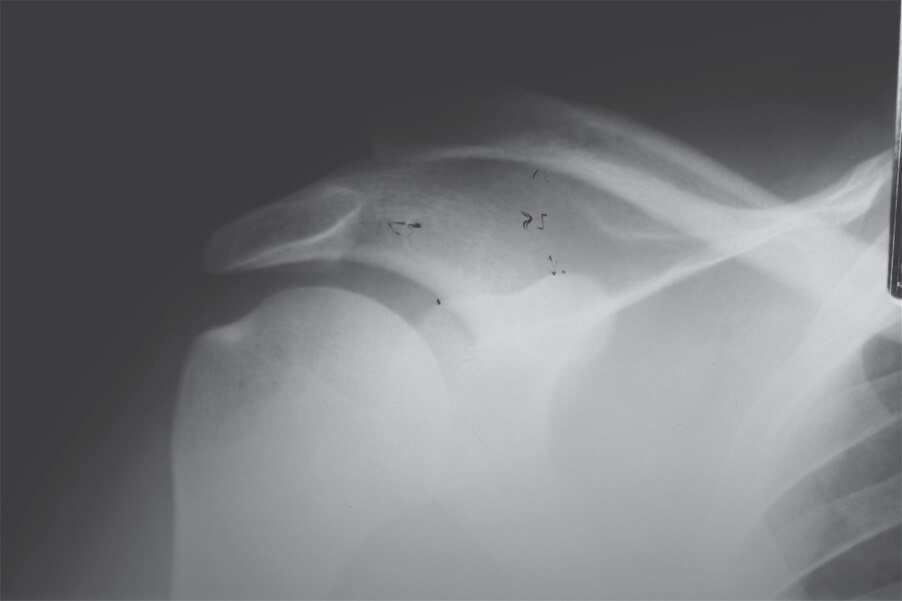 Double Endobutton Technique for Repair of Complete Acromioclavicular Joint Dislocations Figure 7