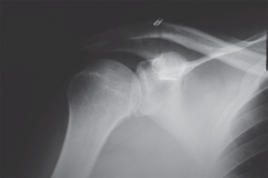 Double Endobutton Technique for Repair of Complete Acromioclavicular Joint Dislocations Figure 8