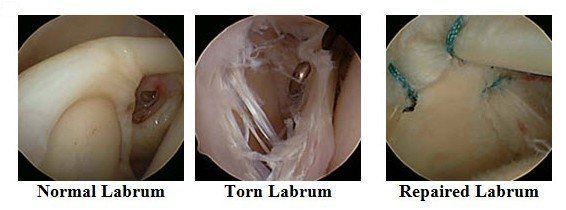 Normal Labrum, Torn Labrum, Repaired Labrum