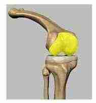 Osteonecrosis of the Knee