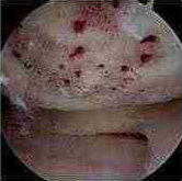 Operation to Stimulate Cartilage Growth (Area Begins to Bleed) procedure photo