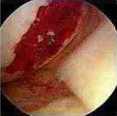 Operation to Stimulate Cartilage Growth (Area Clots) procedure photo