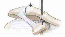 First Stage of AC Joint Separation Surgery