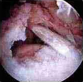 rotator cuff torn photo