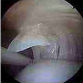 rotator cuff partial tear photo