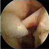 why rotator cuff injuries hurt (anterior impingment) photo